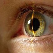 Глаукома - Лечение глаукомы народными средствами