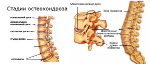Остеохондроз - следим за здоровьем спины