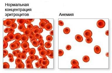 Анемия - Лечение анемии народными средствами