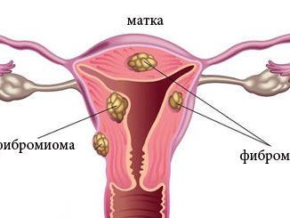 лечение фибромиомы матки народными средствами